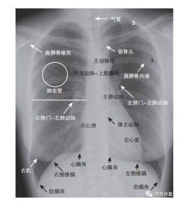 右心格角是哪个位置（右侧心膈角是哪里）