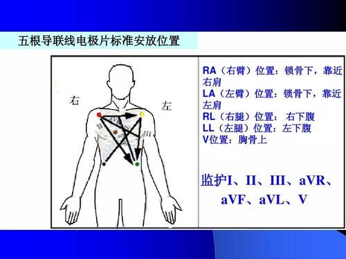 个标准导联IIIIII（标准导联ii导联的连接方法是）