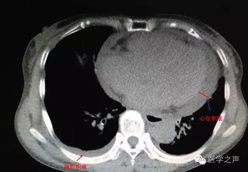 标准ctq（心包积液分度标准CT）-图2