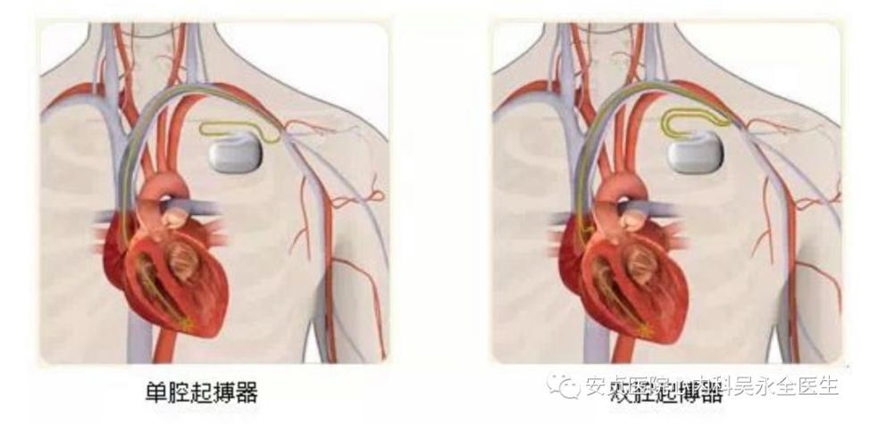 辅助心脏收缩的设备（辅助心脏收缩的设备有哪些）-图2