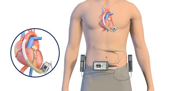 辅助心脏收缩的设备（辅助心脏收缩的设备有哪些）-图1