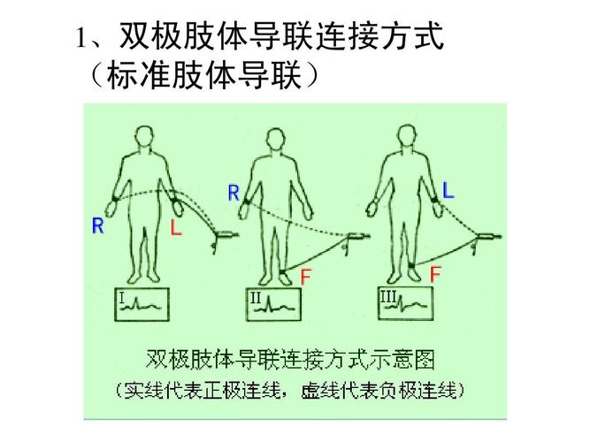 标准双极导联（双极导联有哪些）-图3