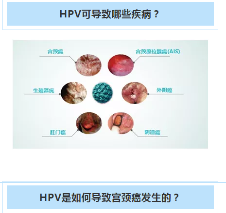 hpvr怎么样（hpvh r）-图2