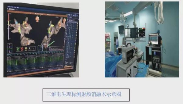 射频医疗标准（医疗射频技术）-图1