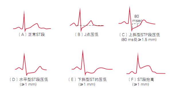 什么是电脉标准（脉电图是啥）-图2